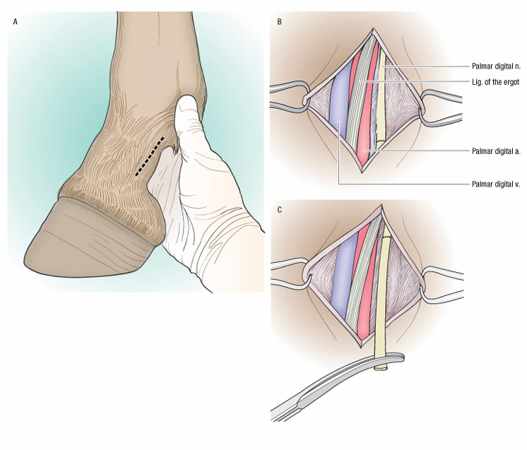 Neurectomia digital palmar