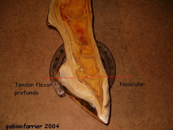 Osso e tendão síndrome do navicular