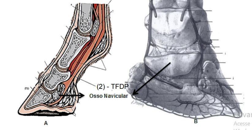 Osso síndrome do navicular